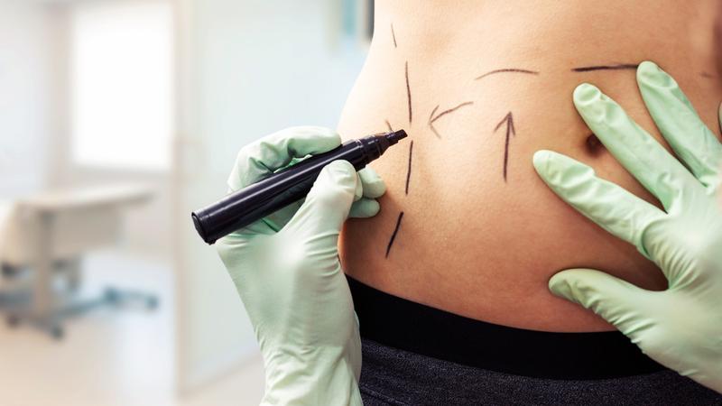 Close up photo of a plastic surgeon drawing marks on a patient.