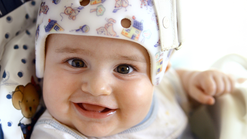 An infant wears a theraputic orthopedic head helmet.
