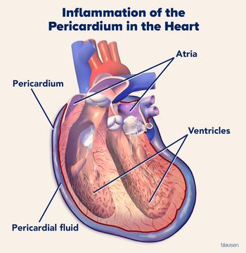 Illustration showing inflammation of the pericardium.