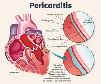 Illustration showing fluid buildup around the heart, called pericarditis.