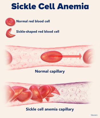 Medical illustration showing normal blood cells and cells with sickle cell anemia.