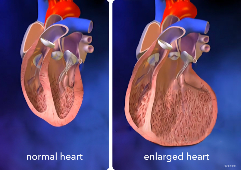 What Does An Enlarged Heart Look Like On An X Ray