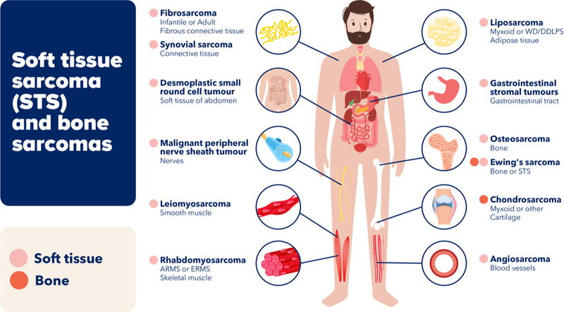 Infographic showing the types of bone and soft tissue sacromas.