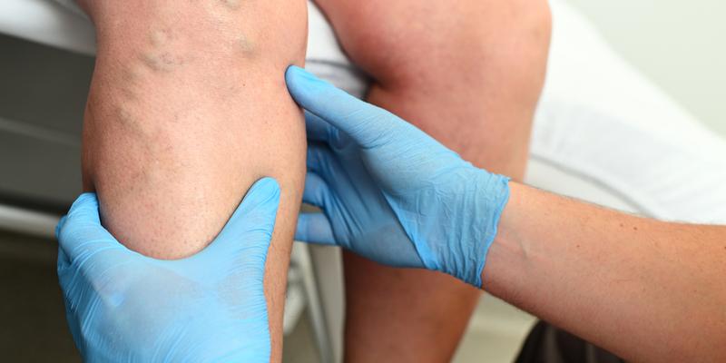 Varicose & Spider Veins, Symptoms and Treatment