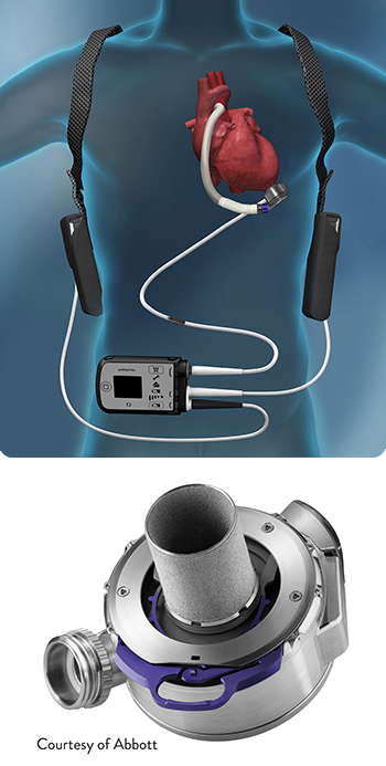 Left Ventricular Assist Devices (LVAD) for Heart Conditions